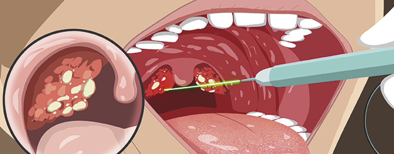 Caseum: conheça os sintomas das bolinhas na garganta